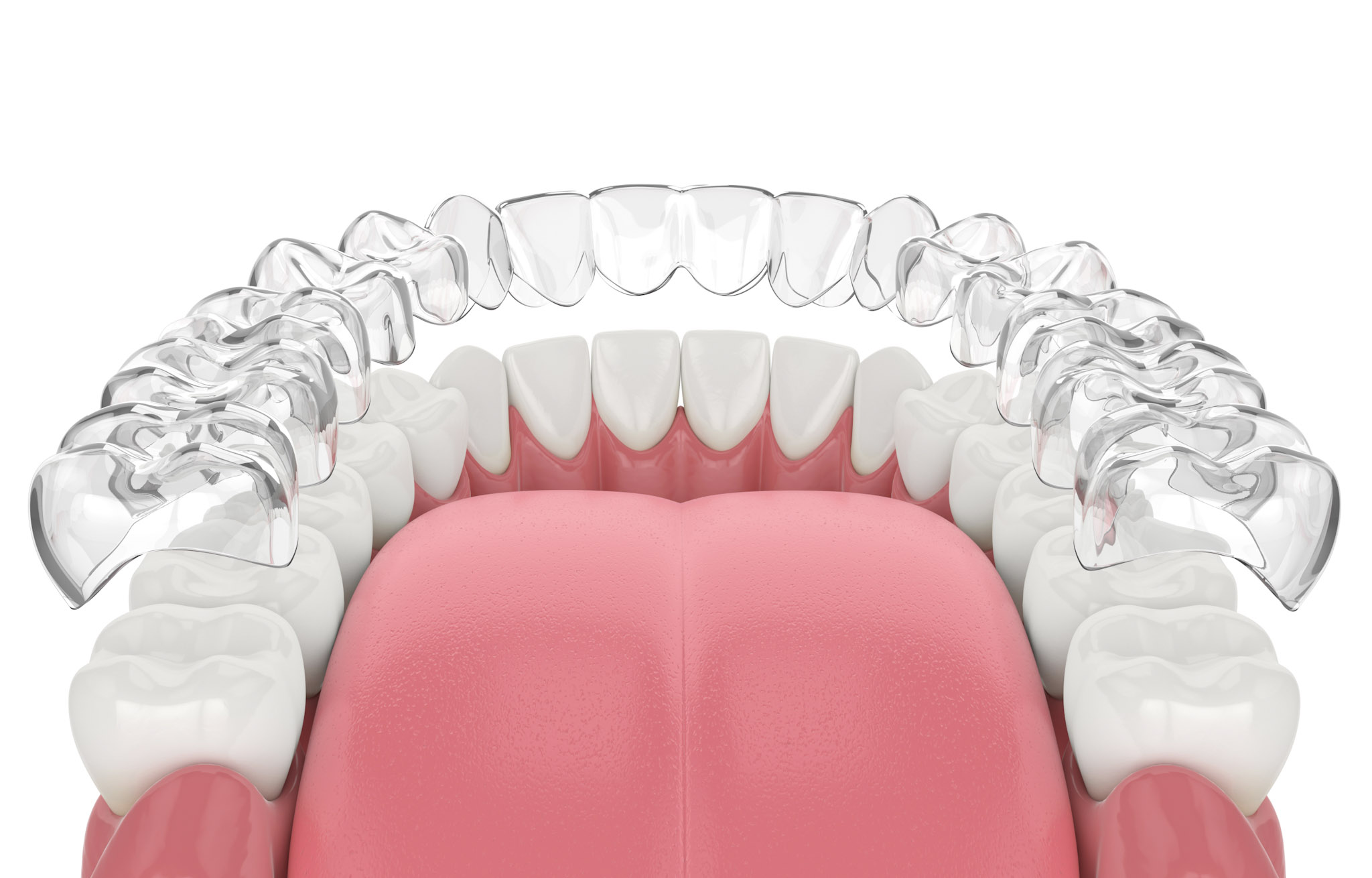 Clear Aligners