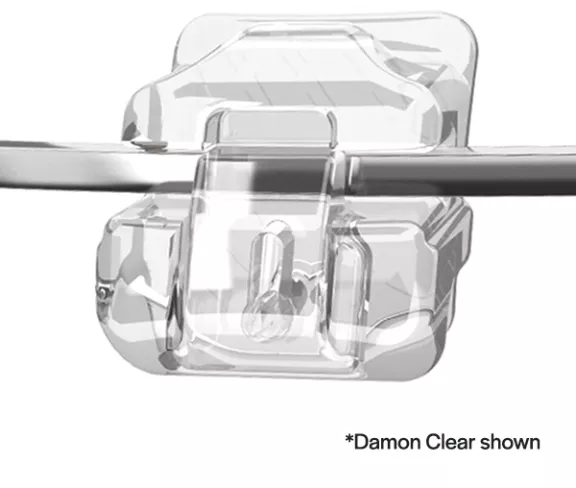 Self-Ligating Braces