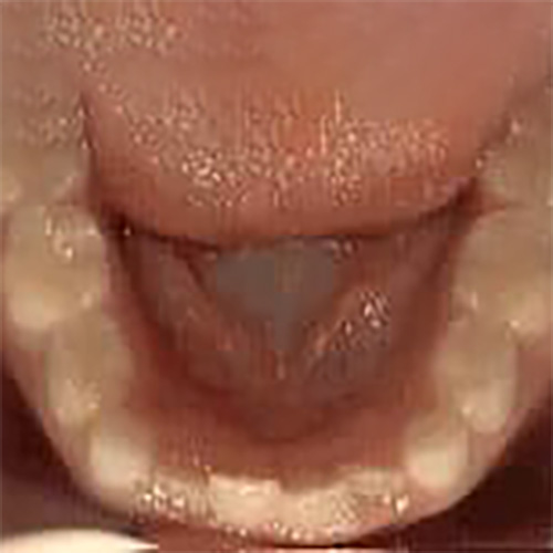 Non-braces Treatment